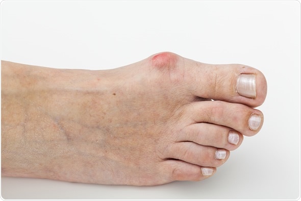 Closeup of a bunion - hallux valgus